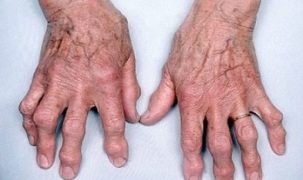 πώς να διακρίνετε την αρθρίτιδα των δακτύλων από την αρθρώσεις